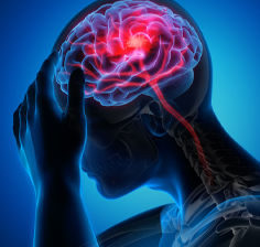 فیزیوتراپی بعد از سکته مغزی